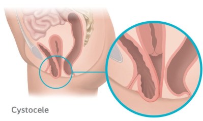 Cystocele Prolapse occurs when the bladder protrudes into the vagina due to the anterior (front) vaginal wall becoming weak.