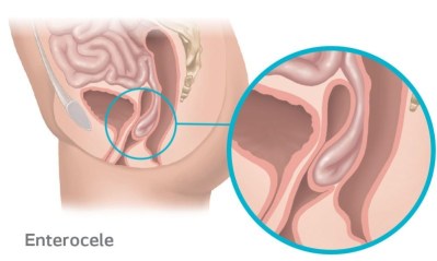 Enterocele Prolapse occurs when the small intestines protrudes into the vagina due to the weakening of the support tissue.