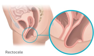 Rectocele Prolapse occurs when the rectum protrudes into the vagina due to the weakening of the supporting tissue.