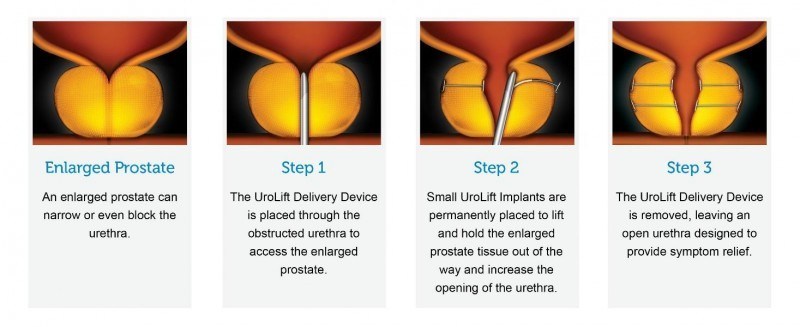 4 step guide to UroLift®